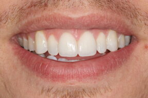After gum graft and orthodontics York - Fresh Dental Smile Clinic