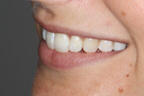 After cosmetic braces York - Fresh Dental Smile Clinic