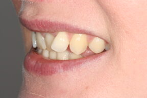 Before cosmetic braces York - Fresh Dental Smile Clinic