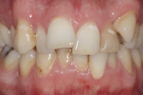 Before cosmetic braces York - Fresh Dental Smile Clinic